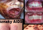 AIDS/HIV