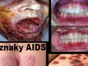 AIDS/HIV