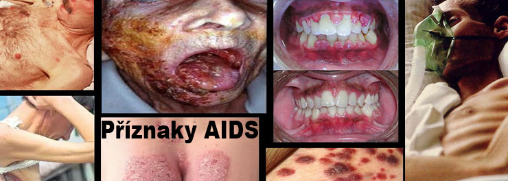 AIDS/HIV